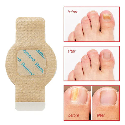 NailHeal™ - Fungal Nail Patches 🌿💅 ( Buy 1 Get 1 Free🔥🔥)